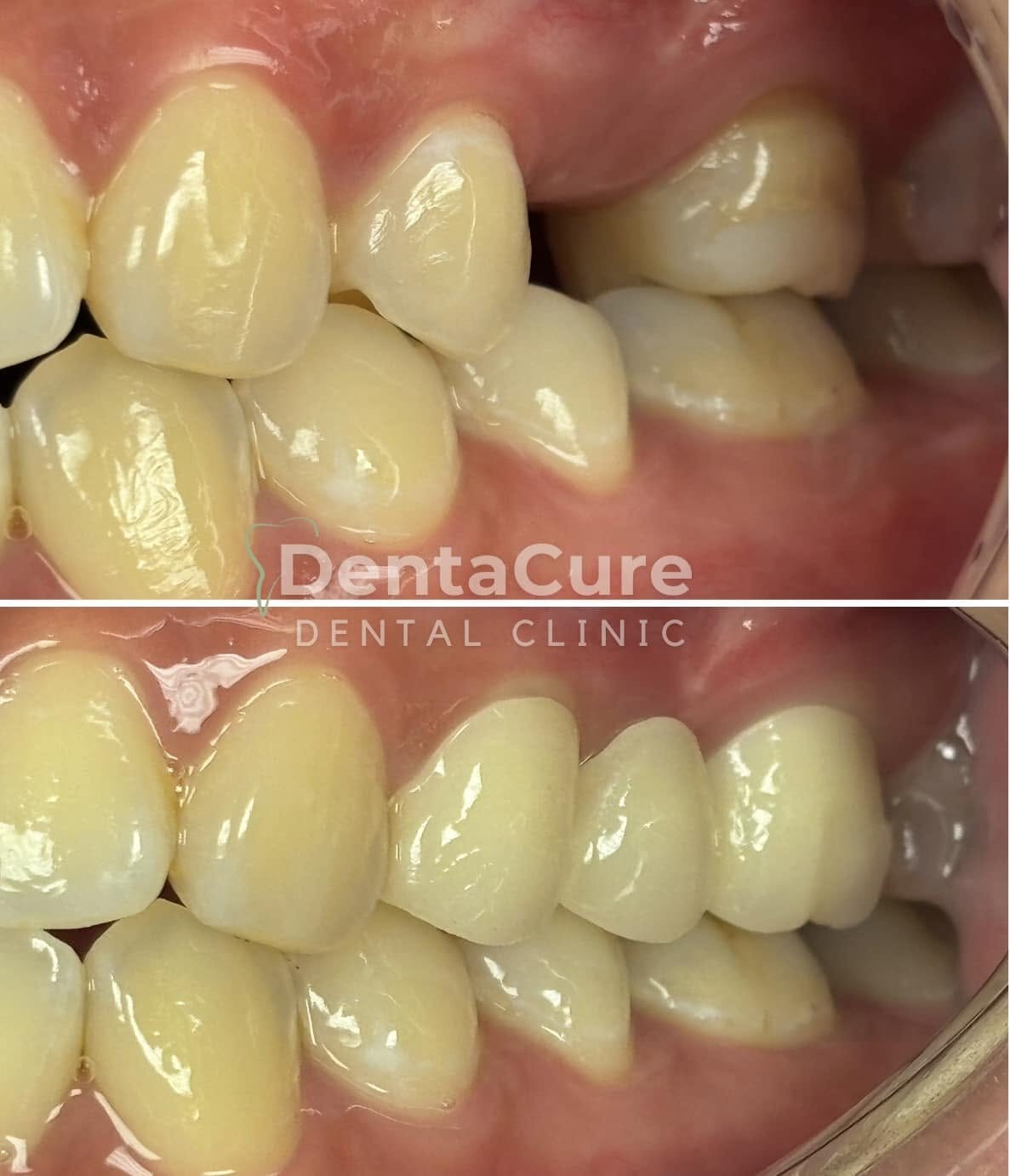 Close-up before and after view of a whitening result at Denta Cure Dental Clinic